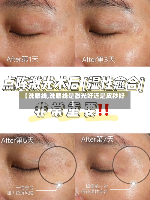 【洗眼线,洗眼线是激光好还是皮秒好】-第2张图片