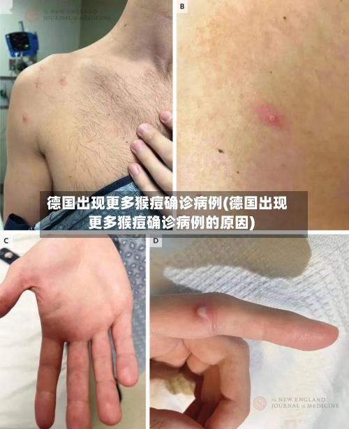 德国出现更多猴痘确诊病例(德国出现更多猴痘确诊病例的原因)