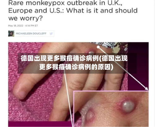 德国出现更多猴痘确诊病例(德国出现更多猴痘确诊病例的原因)-第2张图片