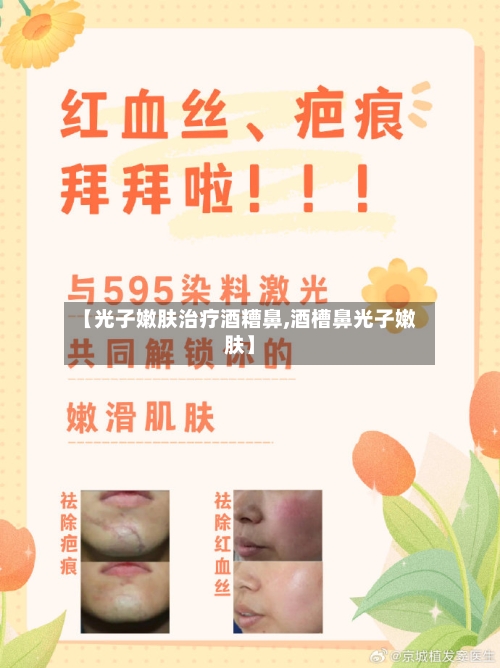 【光子嫩肤治疗酒糟鼻,酒槽鼻光子嫩肤】-第2张图片