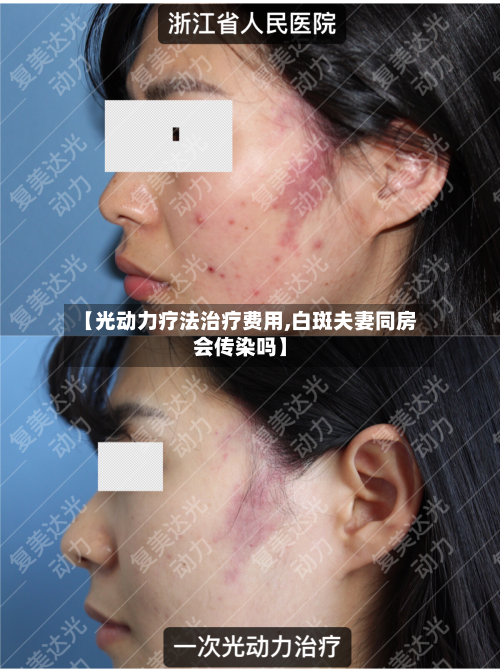 【光动力疗法治疗费用,白斑夫妻同房会传染吗】-第2张图片