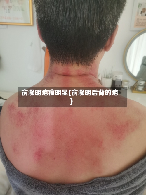 俞灏明疤痕明显(俞灏明后背的疤)
